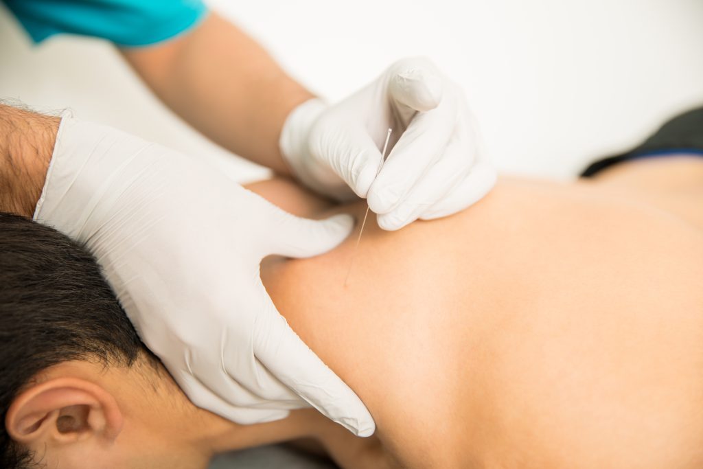 <a href="https://www.freepik.com/free-photo/closeup-shirtless-man-receiving-dry-needling-therapy-from-doctor-clinic_27998904.htm#&position=10&from_view=collections">Image by tonodiaz</a> on Freepik